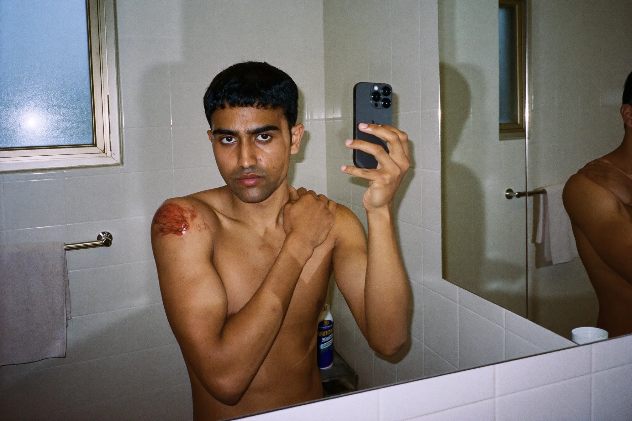 Man photographing a patch of skin on his shoulder with his phone in a bathroom mirror